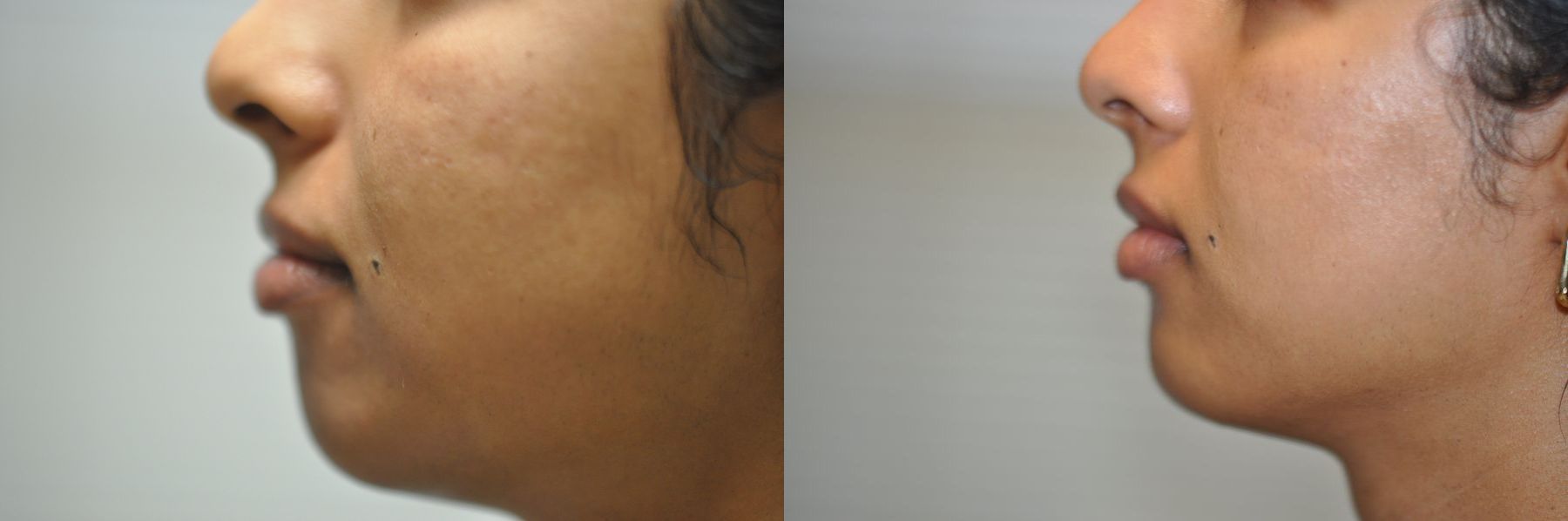 Before and after Chin Augmentation case 35524