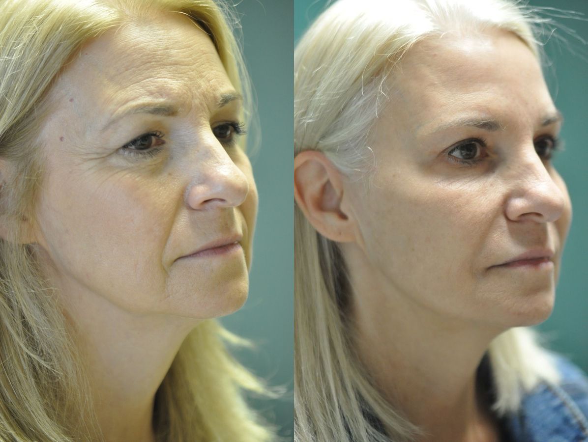 Before and after Combo Procedures - Face case 35321