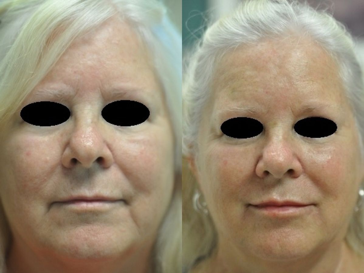 Before and after Combo Procedures - Face case 35359