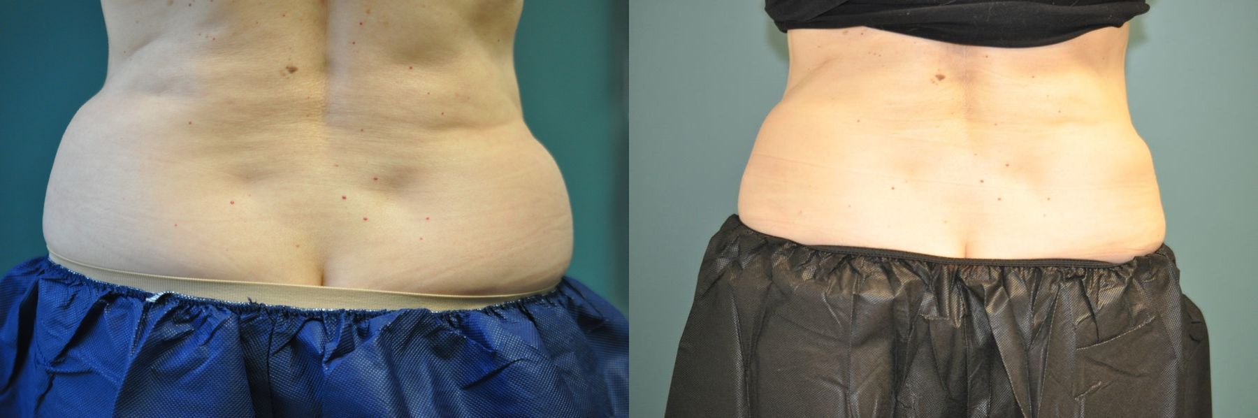 Before and after CoolSculpting® case 35744