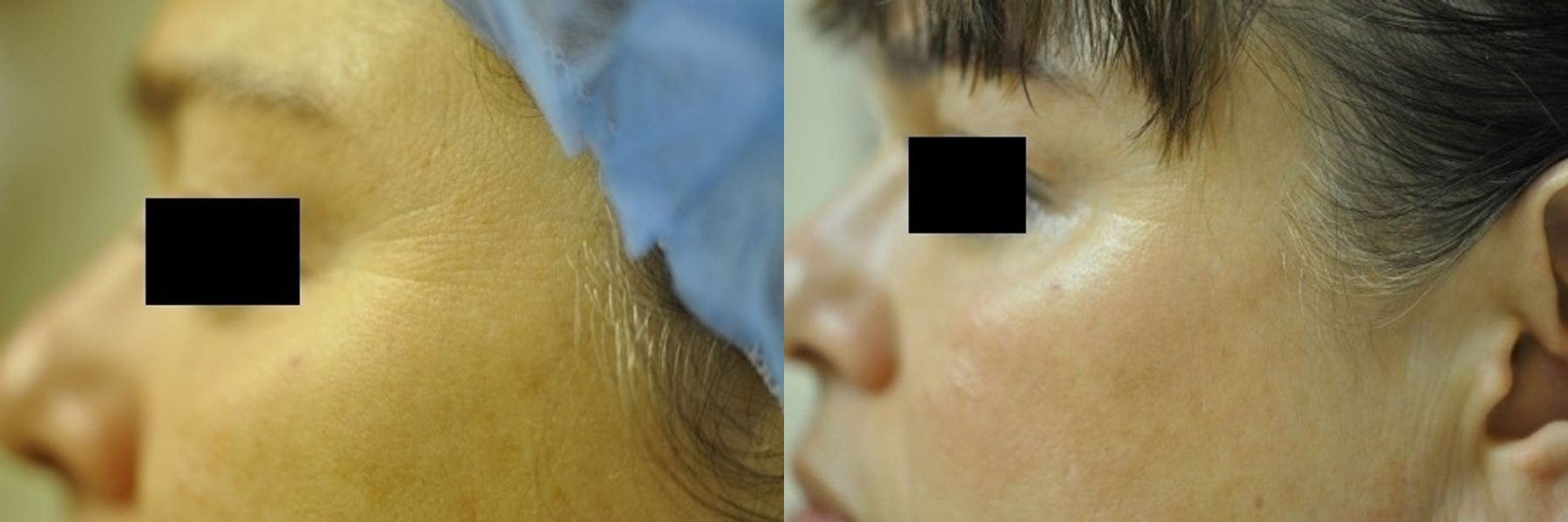 Before and after Crows Feet Creases case 35714