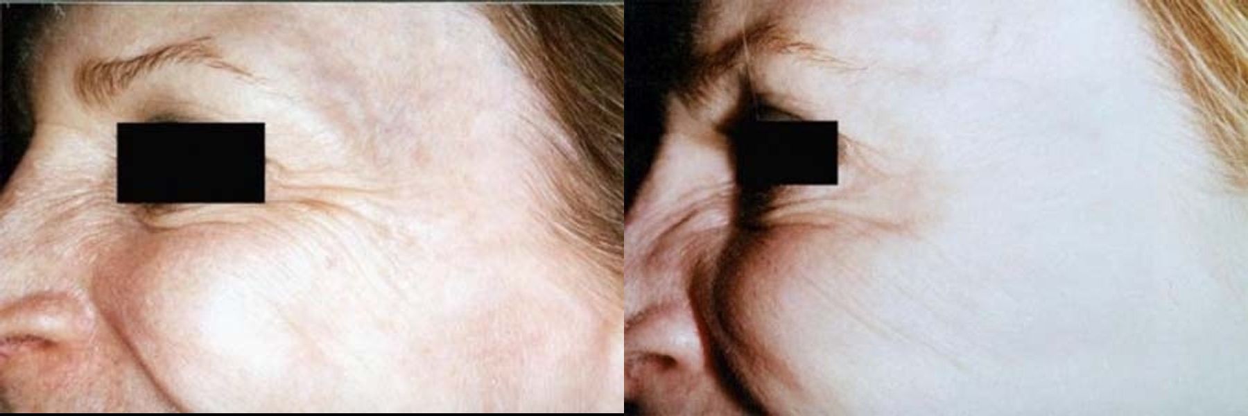 Before and after Crows Feet Creases case 35477