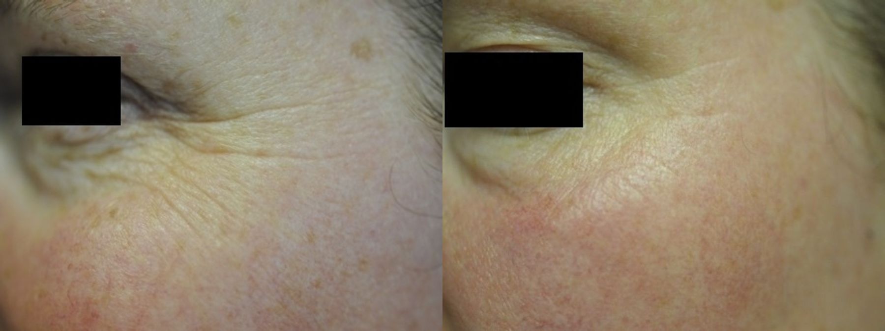 Before and after Crows Feet Creases case 35479