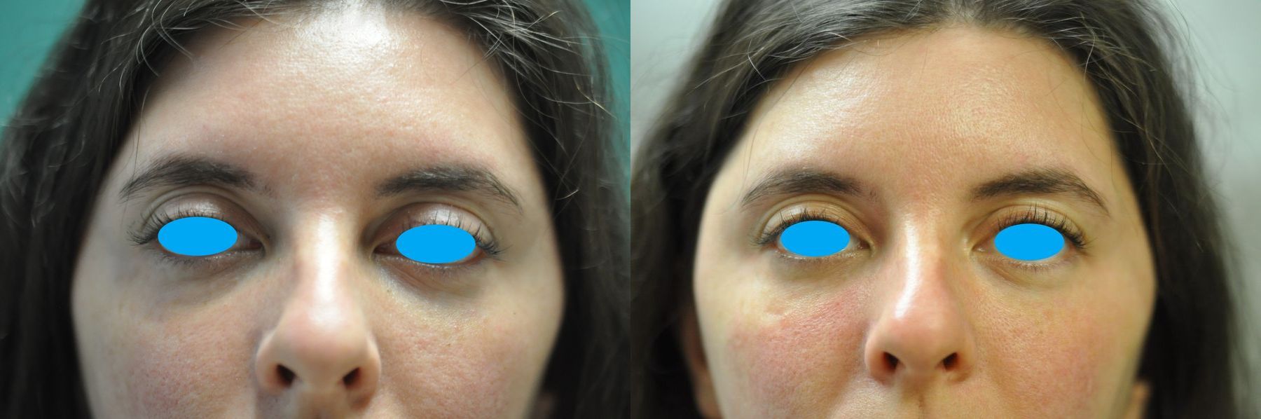 Before and after Dark Circles case 35792