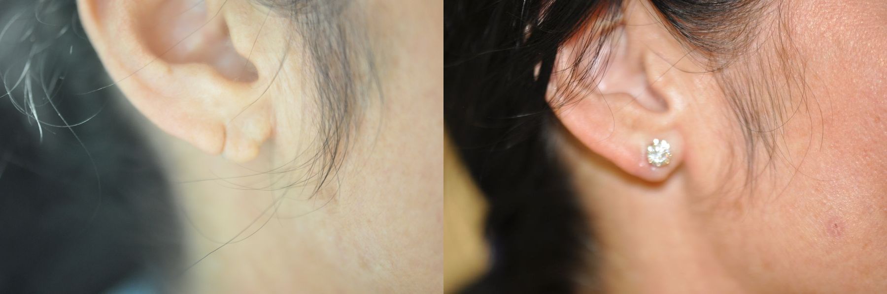 Before and after Earlobe Surgery case 35783