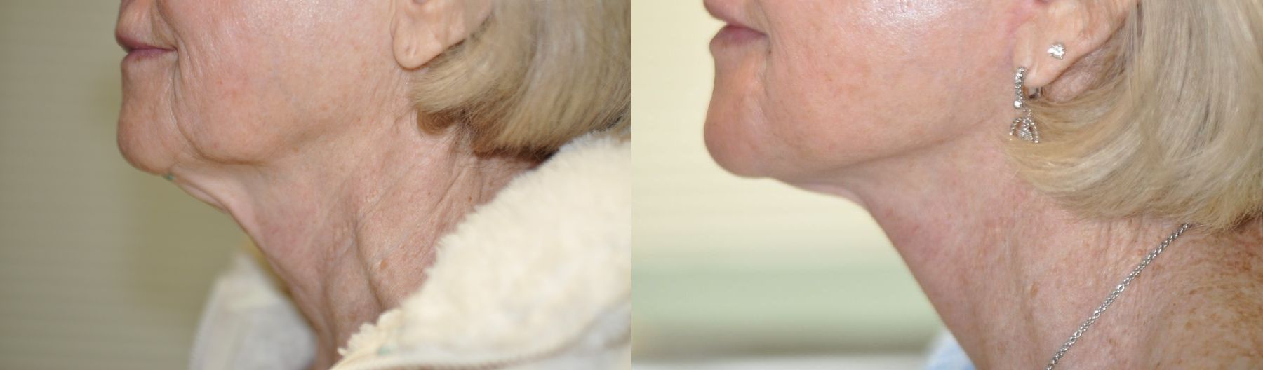 Before and after Facelift case 35770 - Angle 2