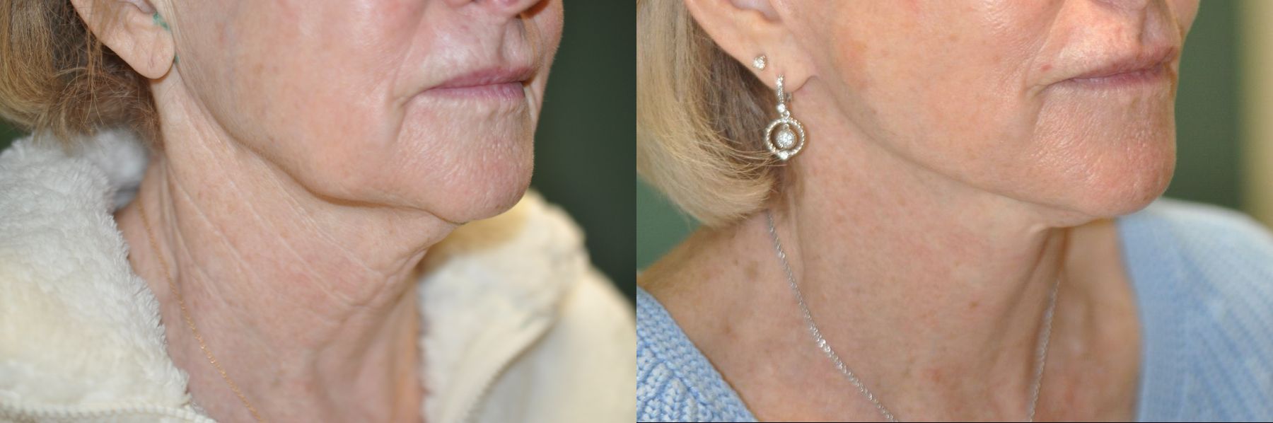Before and after Facelift case 35770 - Angle 4