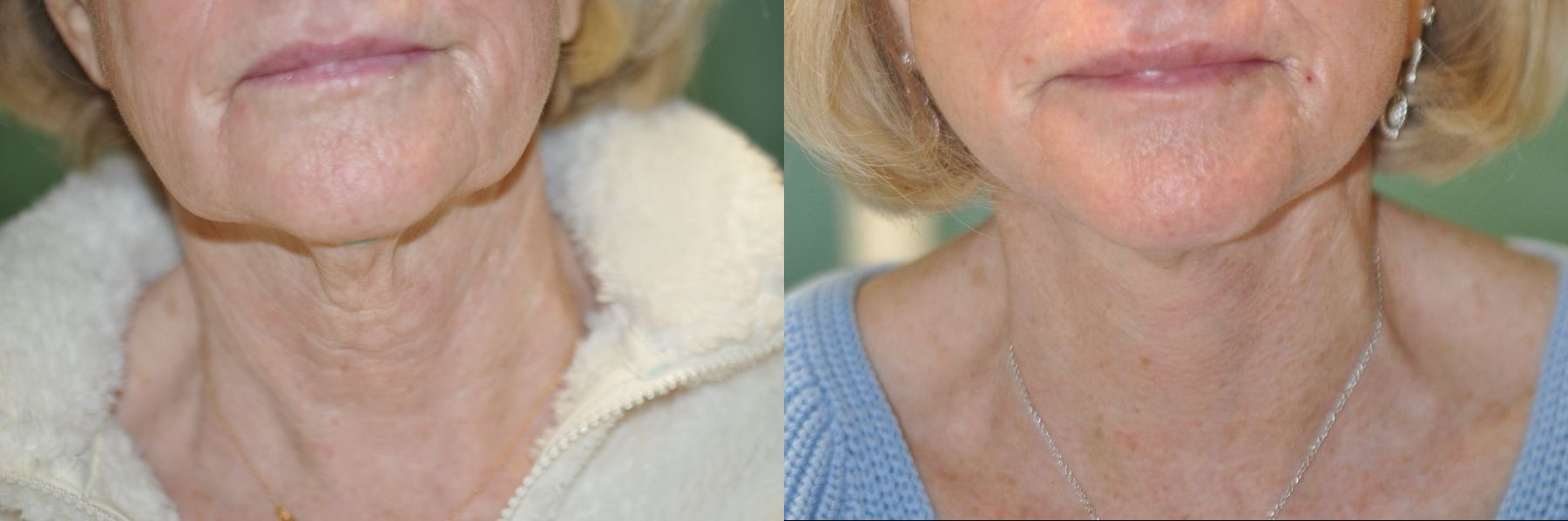Before and after Facelift case 35770