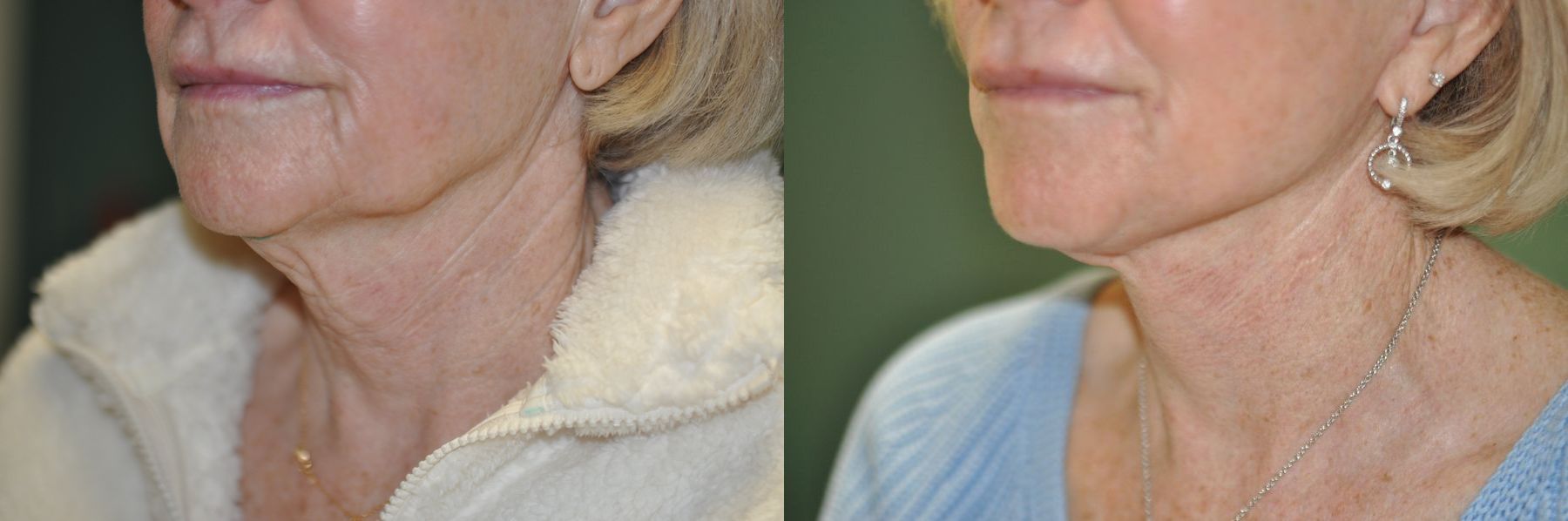 Before and after Facelift case 35770 - Angle 5