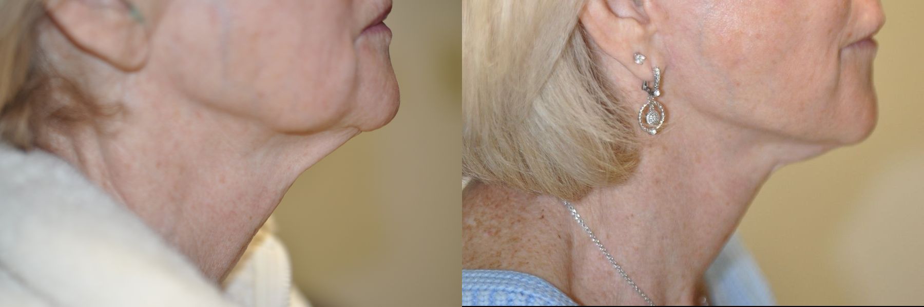 Before and after Facelift case 35770 - Angle 3