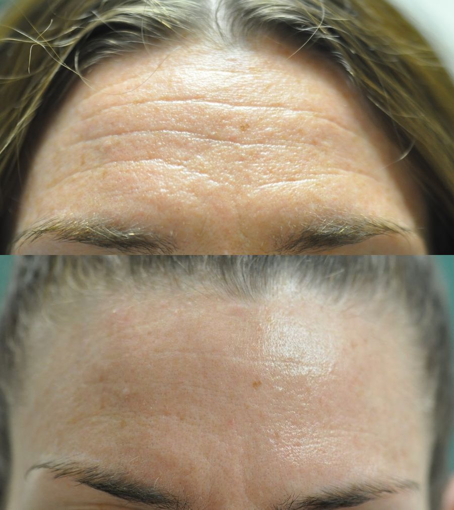 Before and after Forehead Creases case 35805