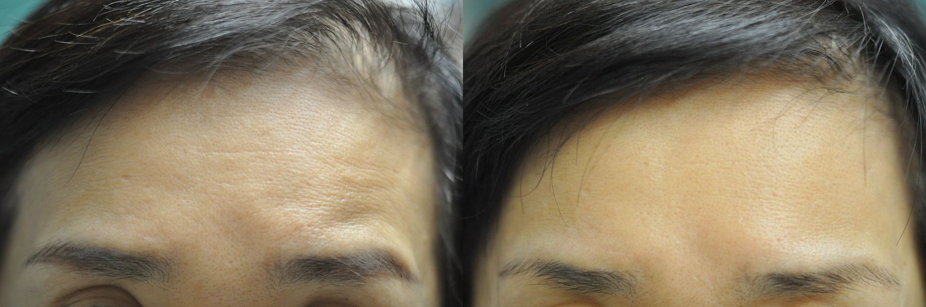 Before and after Forehead Creases case 35742