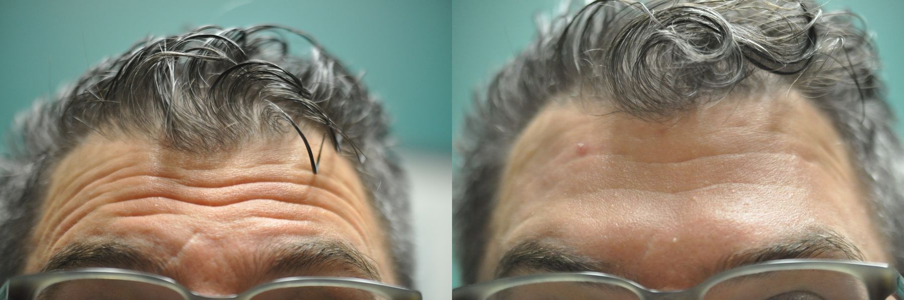 Before and after Forehead Creases case 35767 - Angle 2