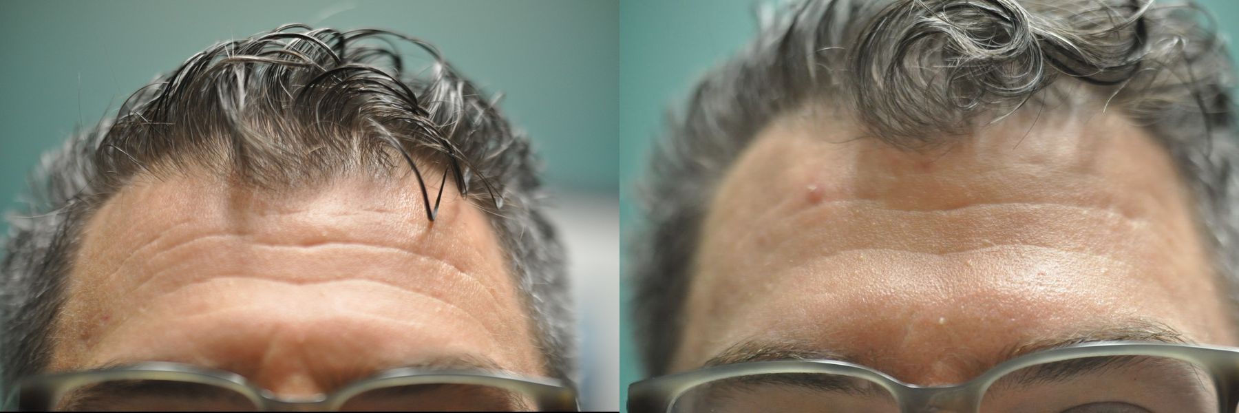 Before and after Forehead Creases case 35767