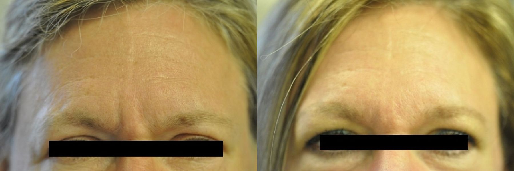 Threading Frown Line Case 25491