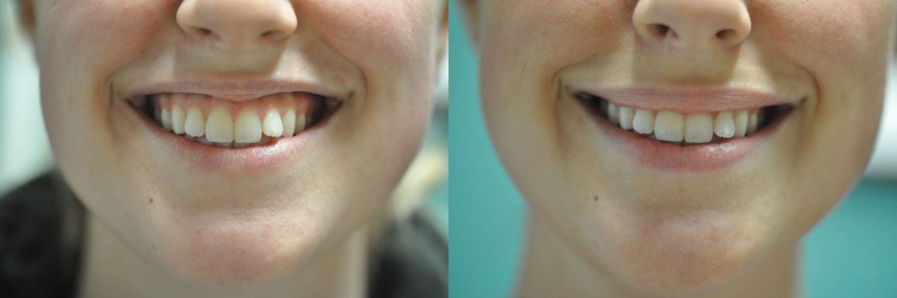 Before and after Gummy Smile case 35759