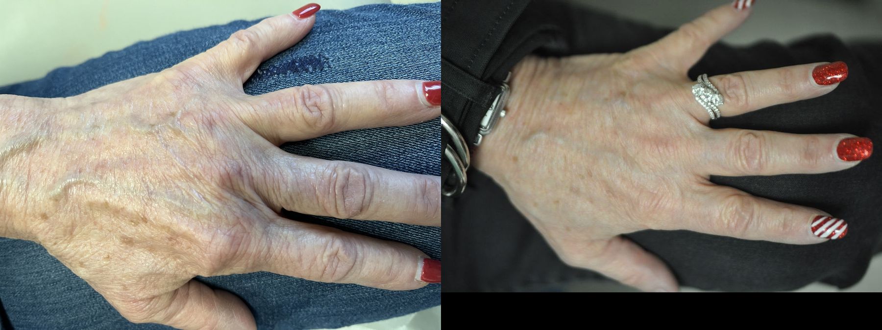 Before and after Hand Augmentation case 35650