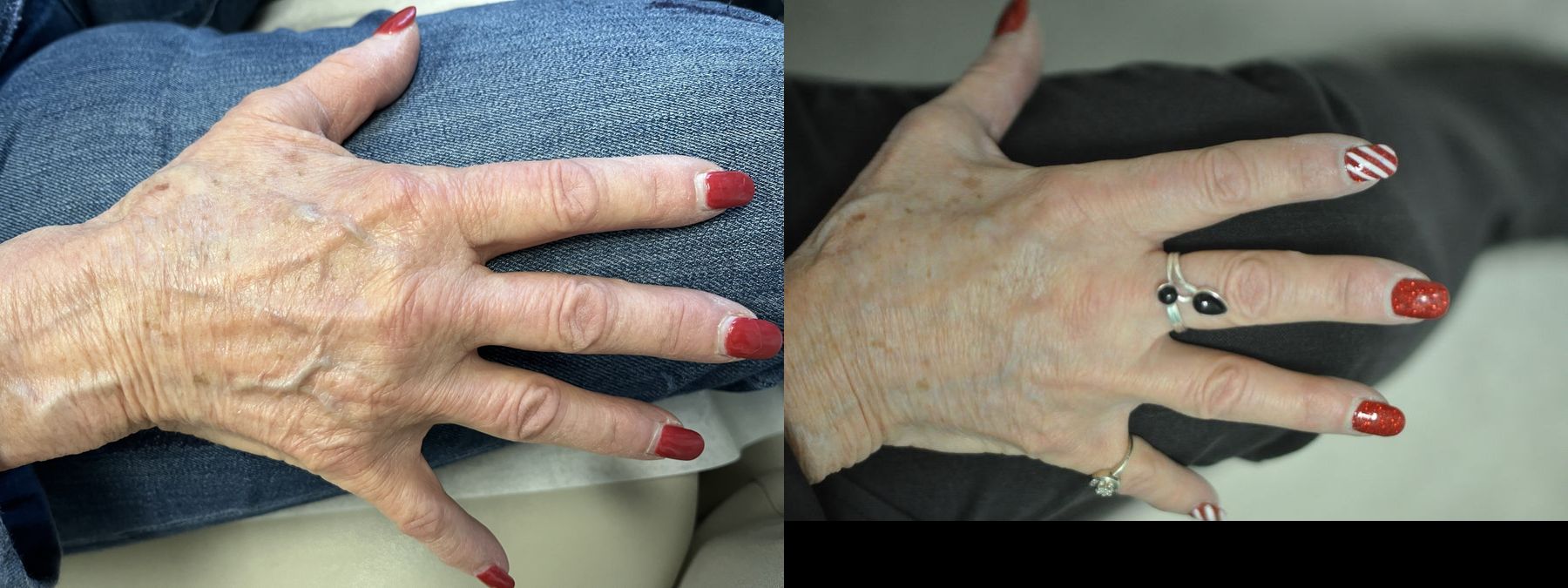 Before and after Hand Augmentation case 35650 - Angle 2
