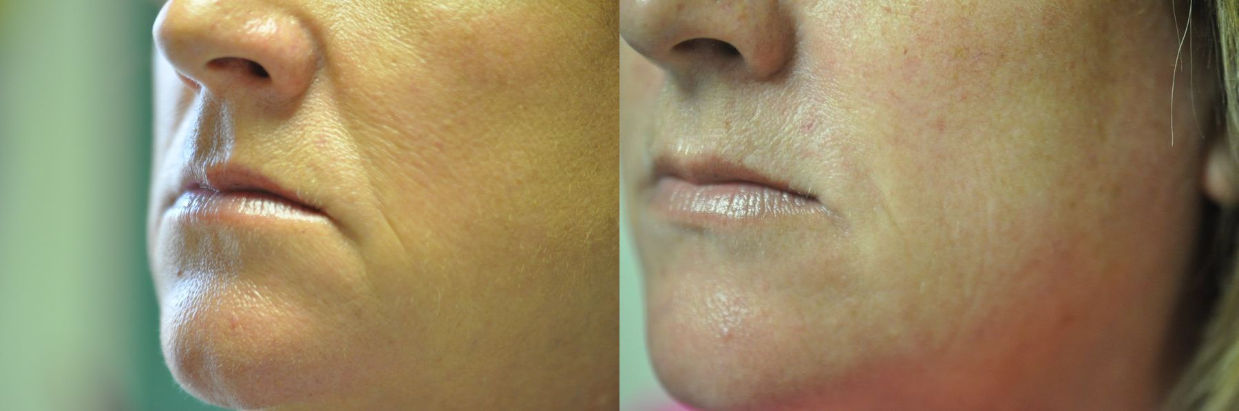 Before and after Juvéderm® XC case 35725 - Angle 2