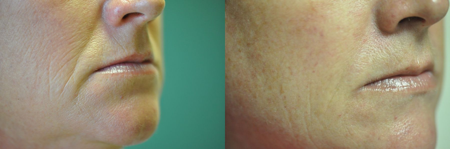 Before and after Juvéderm® XC case 35725