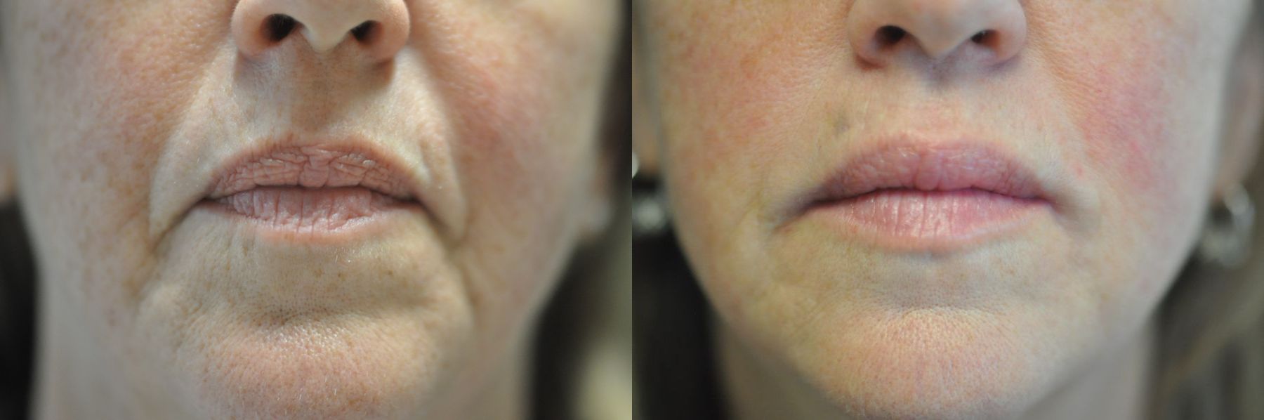 Before and after Marionette Lines case 43083