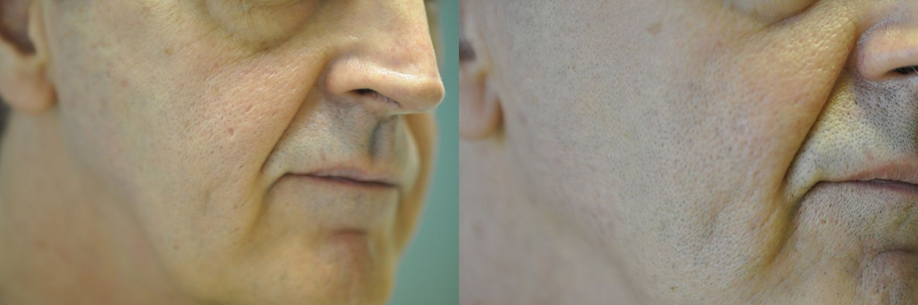 Before and after Laser Skin Resurfacing case 35450
