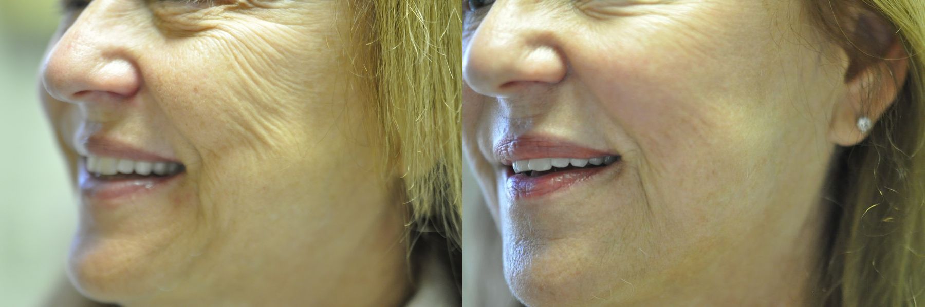 Before and after Laser Skin Resurfacing case 35449