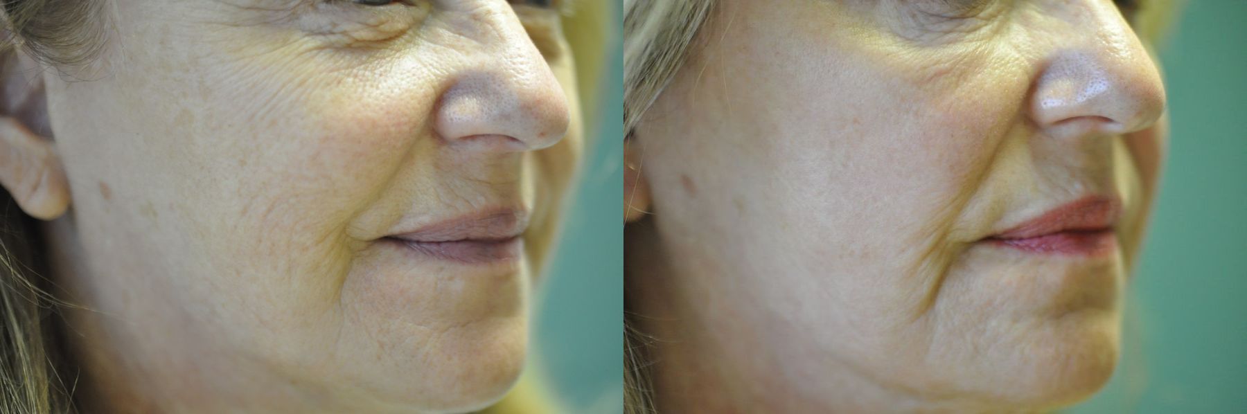 Before and after Laser Skin Resurfacing case 35449 - Angle 3