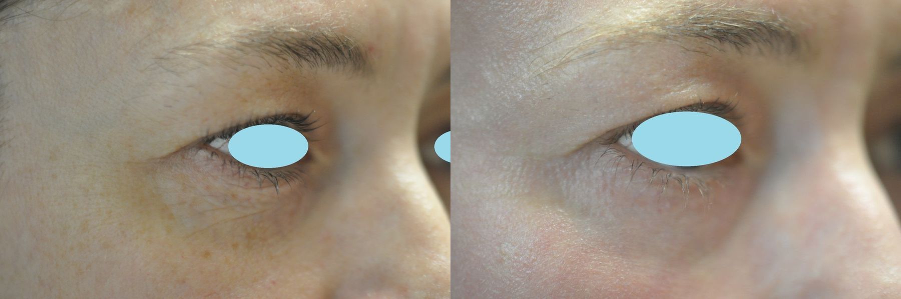 Before and after Laser Skin Resurfacing case 35817