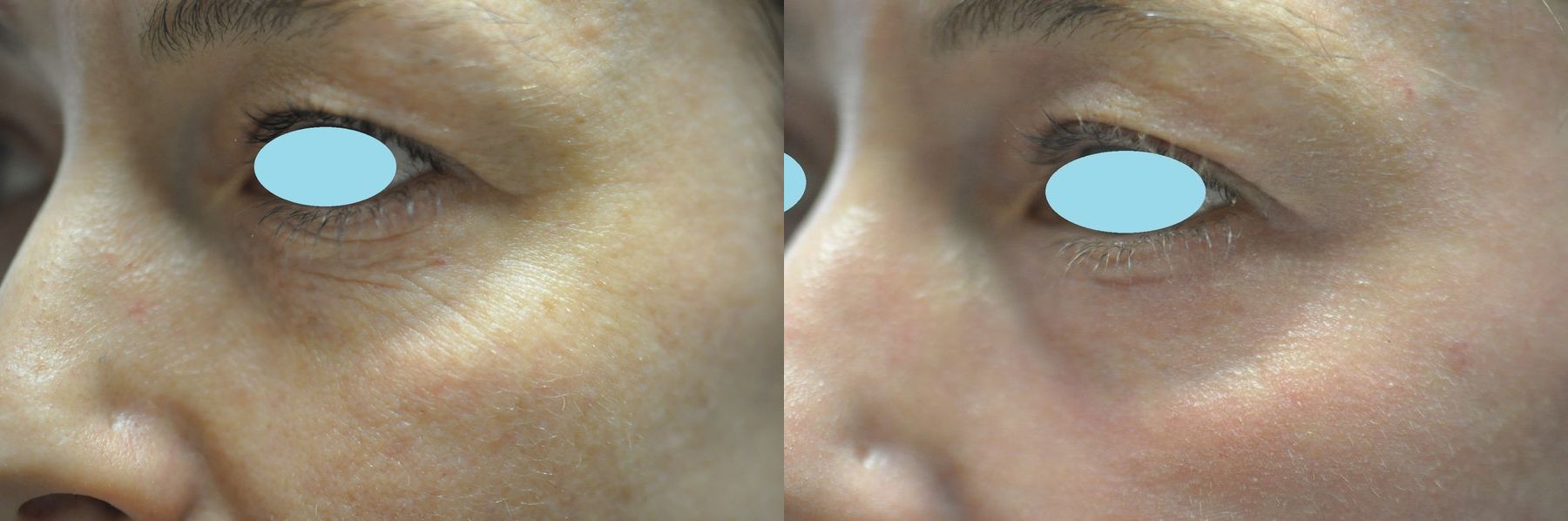 Before and after Laser Skin Resurfacing case 35817 - Angle 2