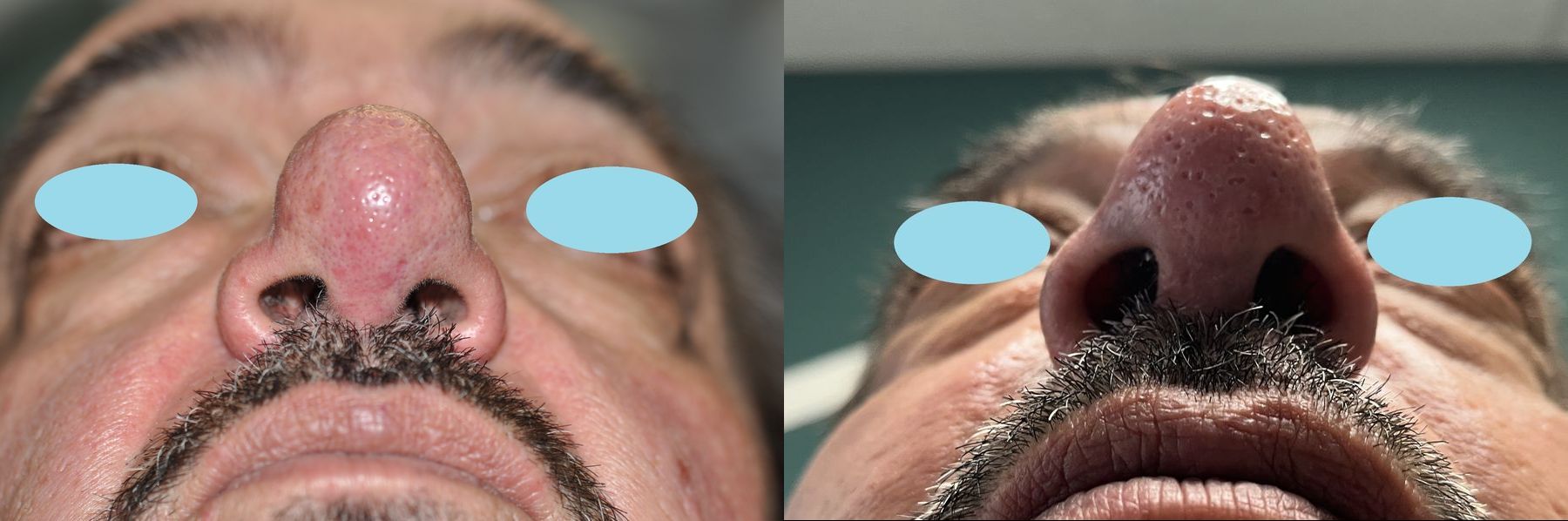 Before and after Laser Skin Resurfacing case 35670