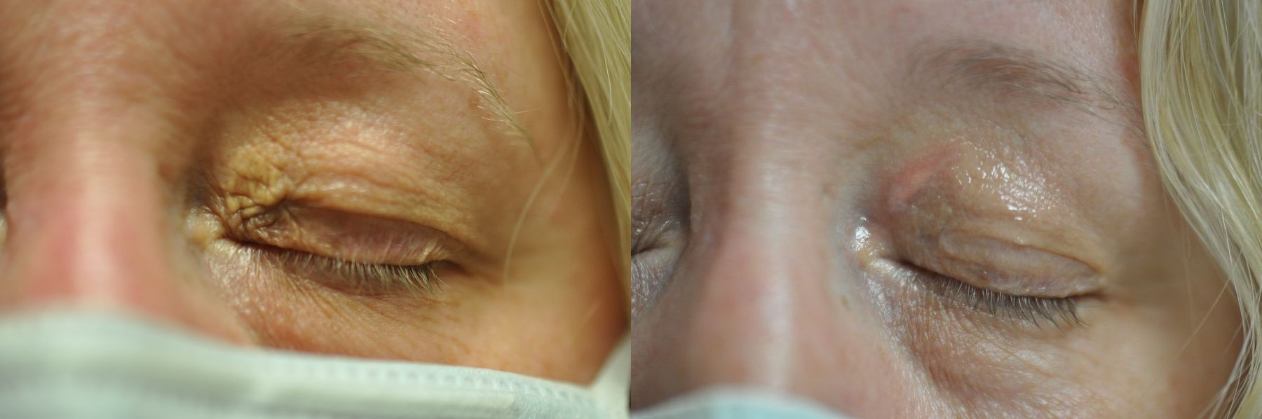 Before and after Laser Skin Resurfacing case 35669