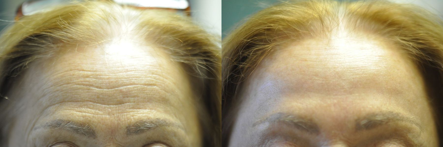 Before and after Laser Skin Resurfacing case 35449 - Angle 2