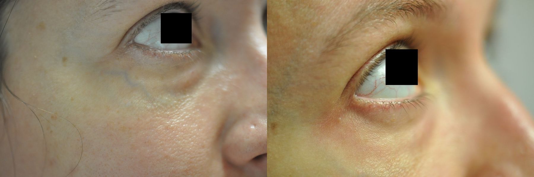 Before and after Laser for Veins and Redness case 35444