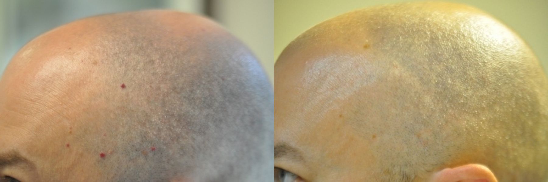 Before and after Laser for Veins and Redness case 35499