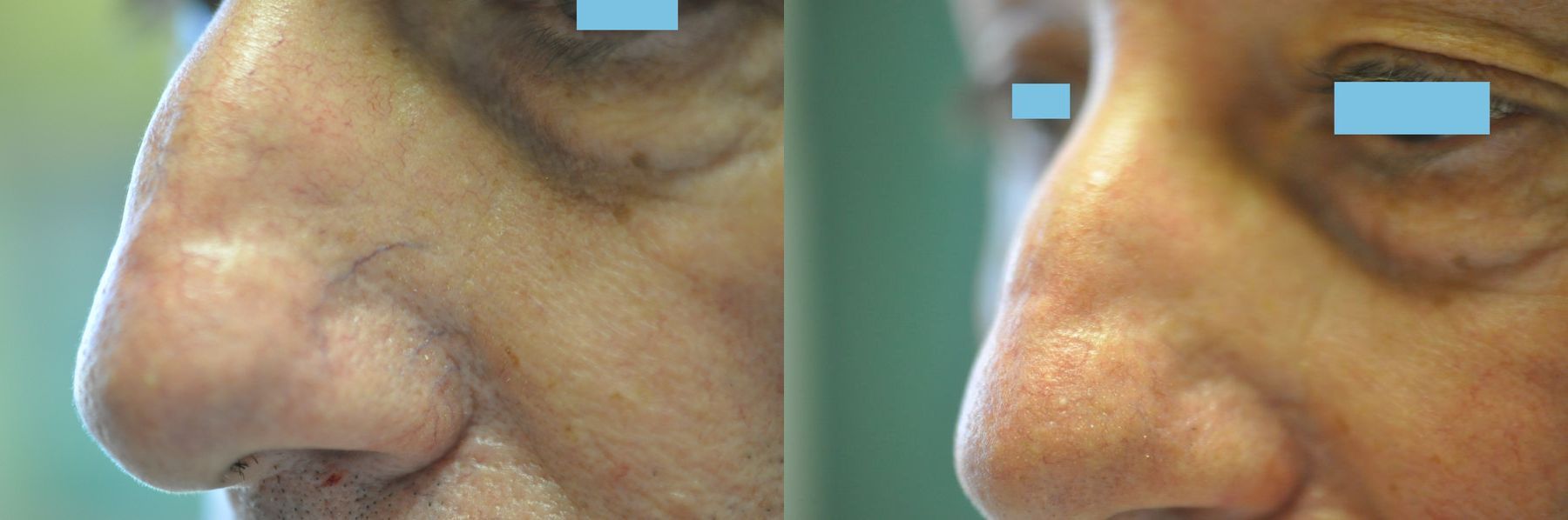 Before and after Laser for Veins and Redness case 35503