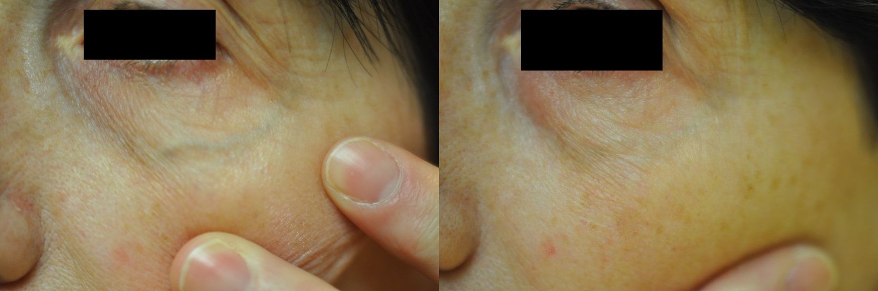 Before and after Laser for Veins and Redness case 35445
