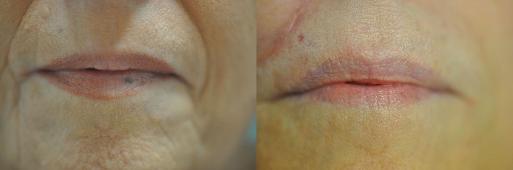Before and after Laser for Veins and Redness case 35816