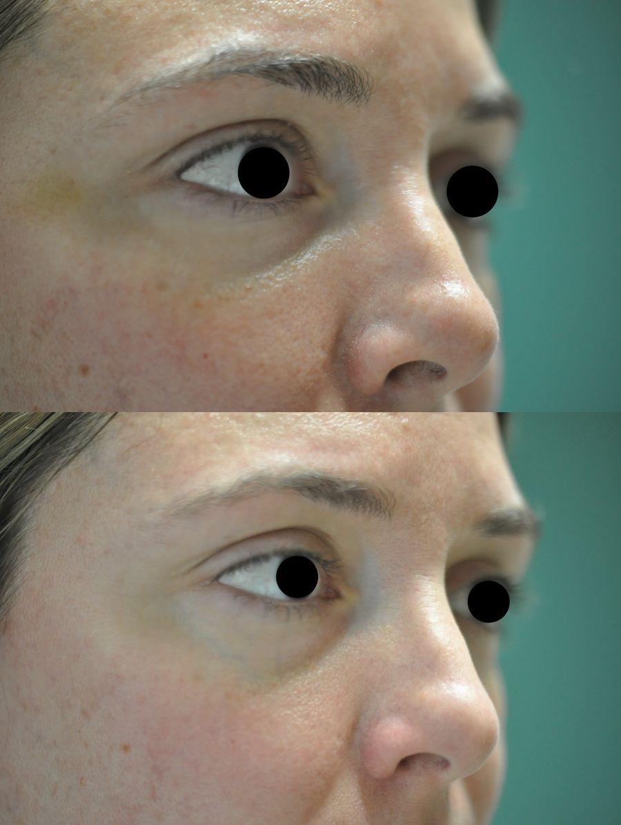 Before and after Laser for Veins and Redness case 49563
