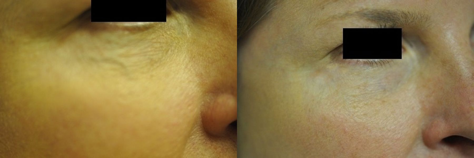 Before and after Laser for Veins and Redness case 35438