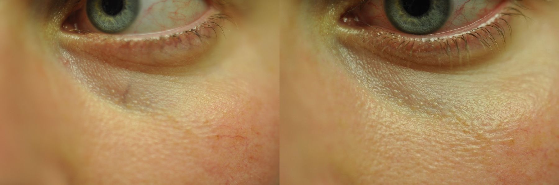 Before and after Laser for Veins and Redness case 35470