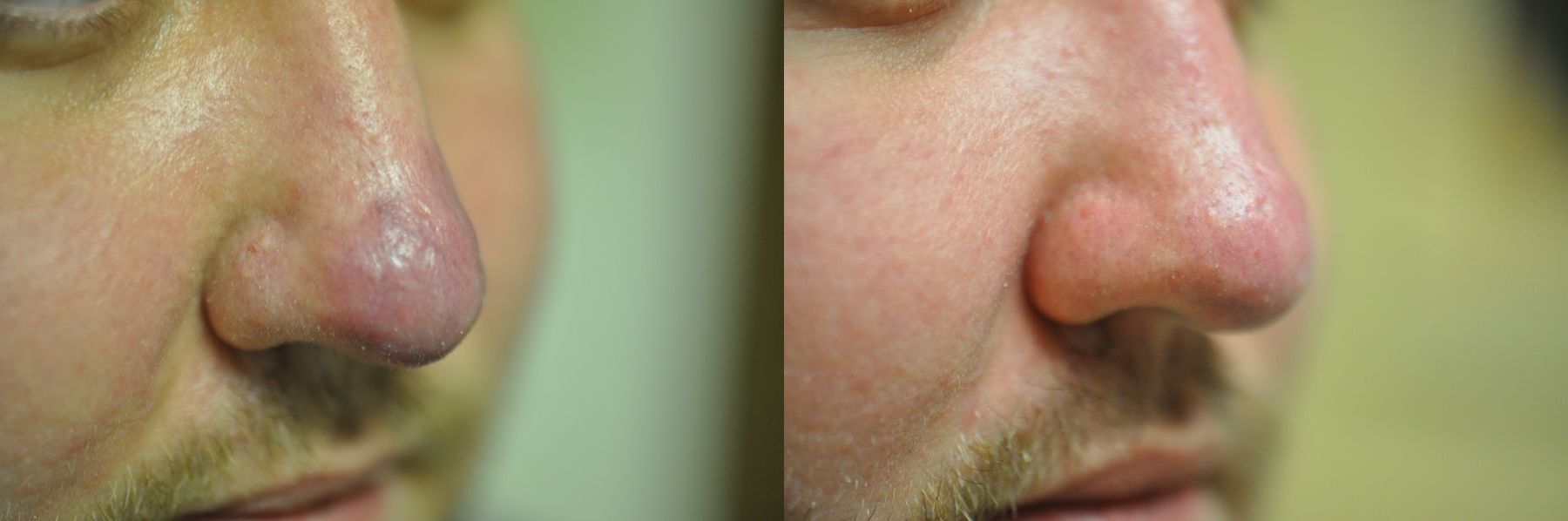 Before and after Laser for Veins and Redness case 35504