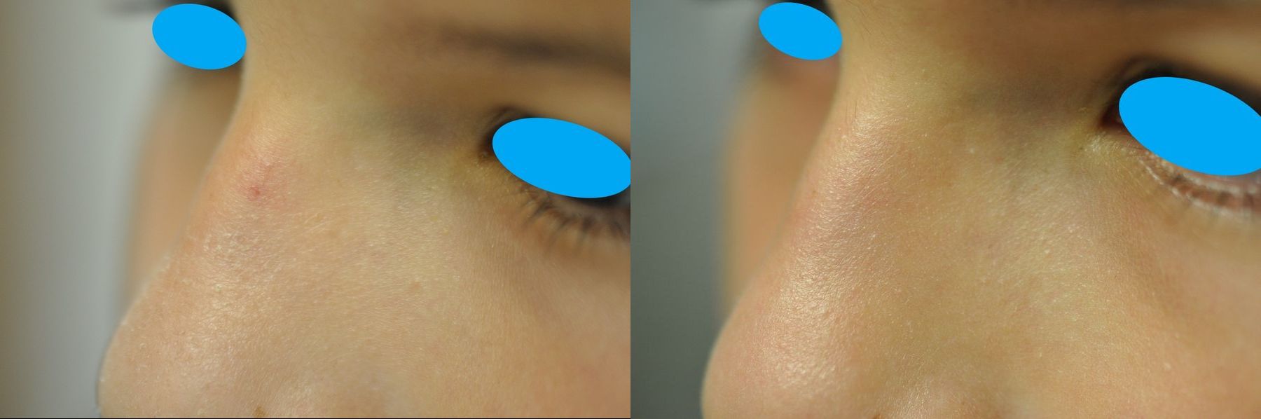 Before and after Laser for Veins and Redness case 35505