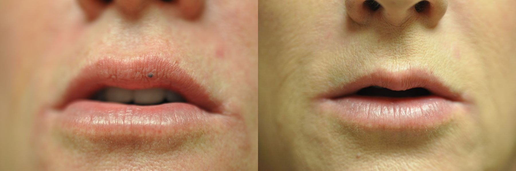 Before and after Laser for Veins and Redness case 35506