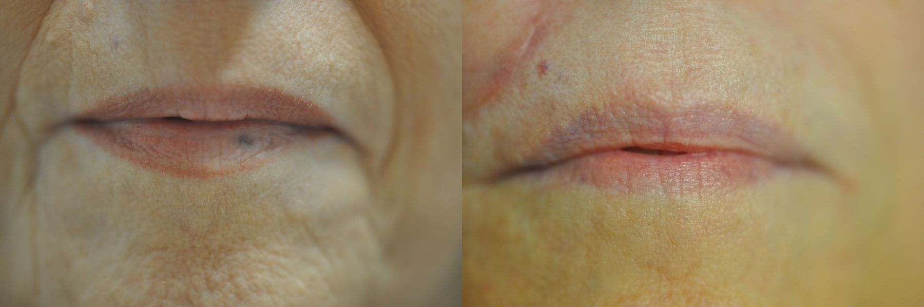 Before and after Laser for Veins and Redness case 43080