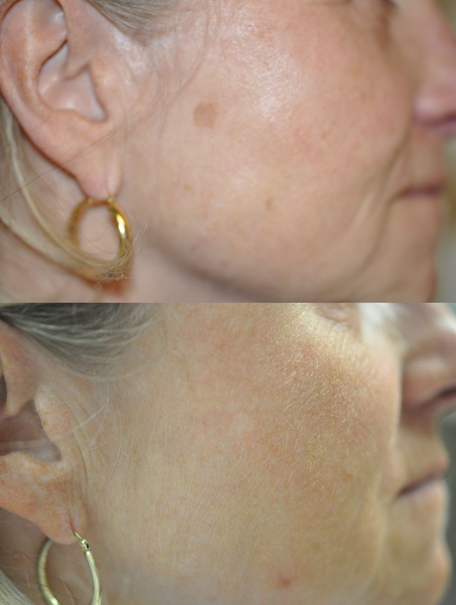 Before and after Lasers for Brown Spots case 43426