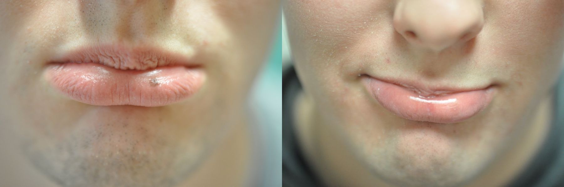 Before and after Lasers for Brown Spots case 35642