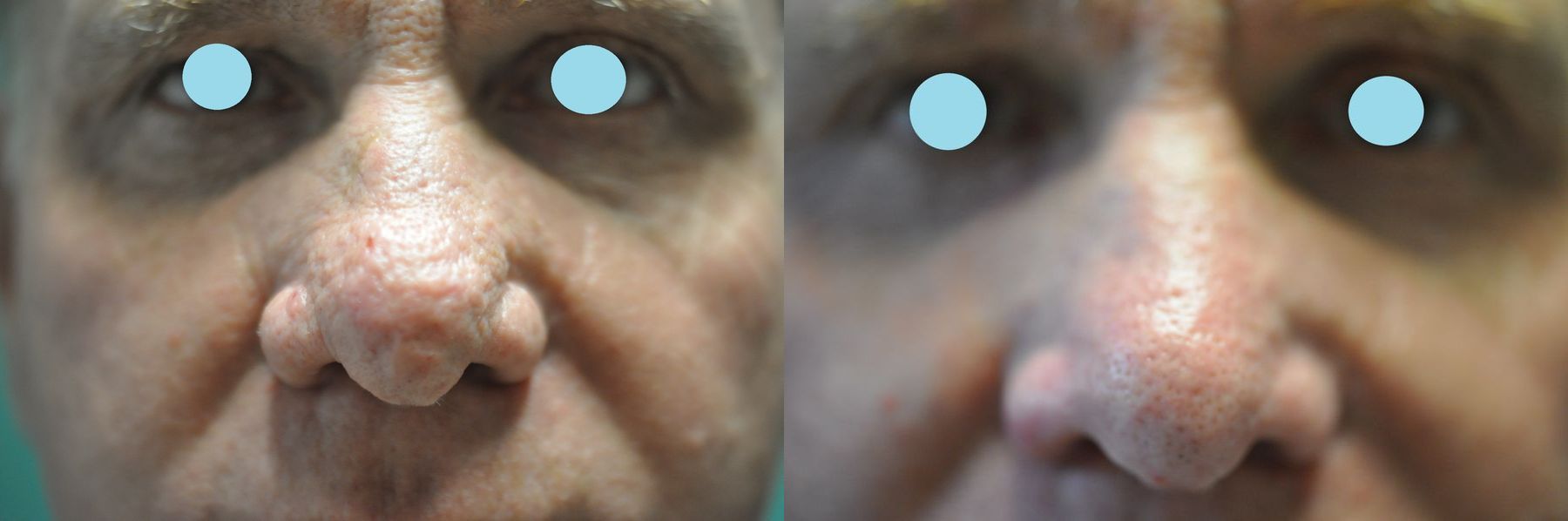 Before and after Lasers for Rhinophyma case 35824 - Angle 2
