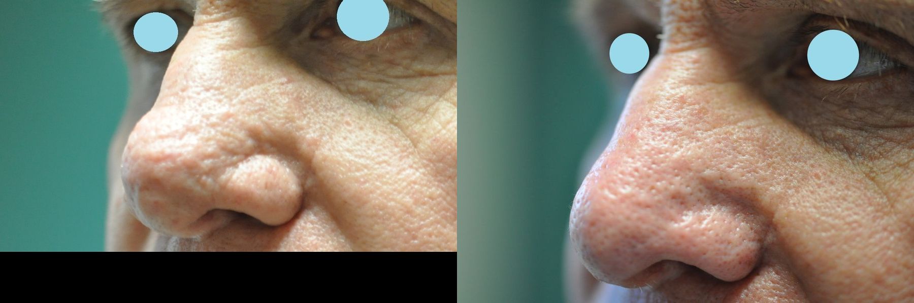 Before and after Lasers for Rhinophyma case 35824 - Angle 3