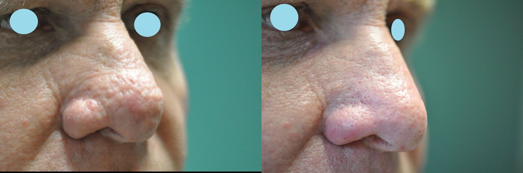 Before and after Lasers for Rhinophyma case 35824 - Angle 5